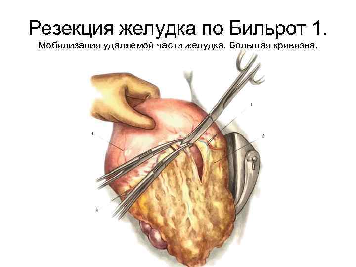 Резекция желудка по Бильрот 1. Мобилизация удаляемой части желудка. Большая кривизна. 