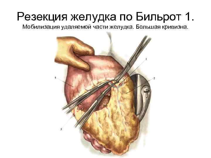 Резекция желудка по Бильрот 1. Мобилизация удаляемой части желудка. Большая кривизна. 