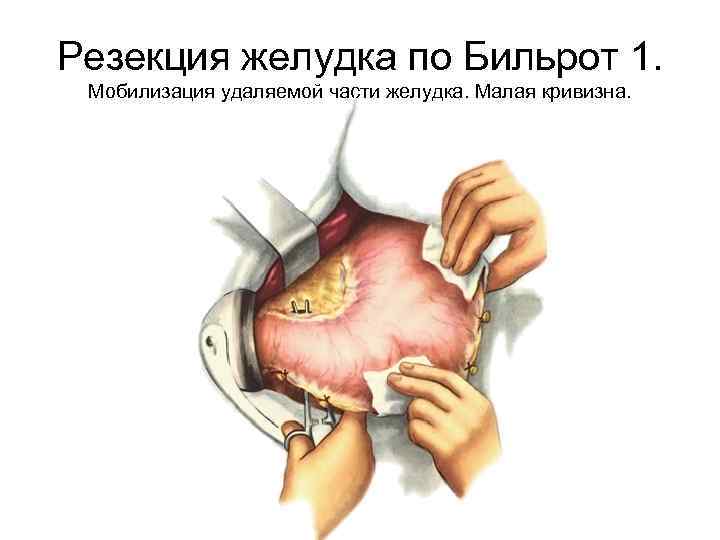 Резекция желудка по Бильрот 1. Мобилизация удаляемой части желудка. Малая кривизна. 