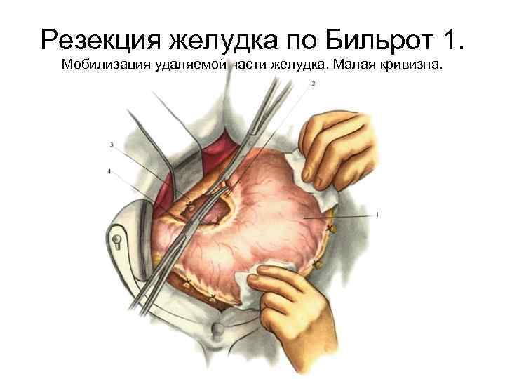 Резекция желудка по Бильрот 1. Мобилизация удаляемой части желудка. Малая кривизна. 