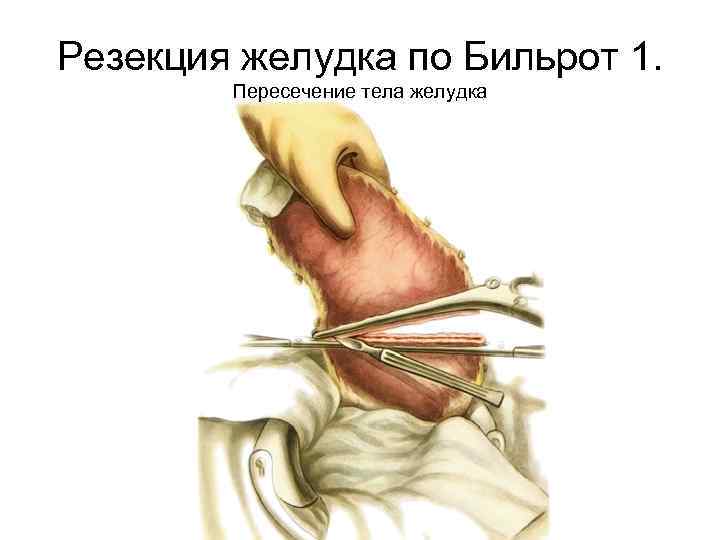Резекция желудка по Бильрот 1. Пересечение тела желудка 