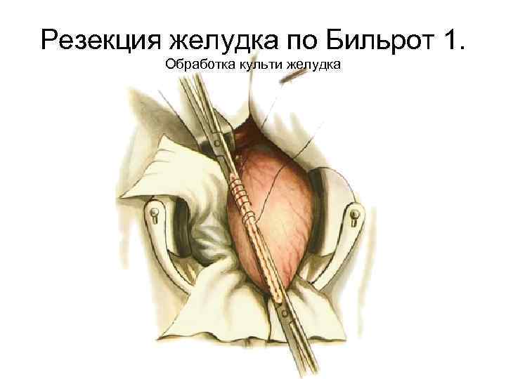 Резекция желудка по Бильрот 1. Обработка культи желудка 
