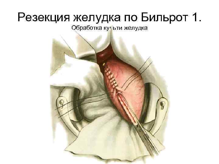 Резекция желудка по Бильрот 1. Обработка культи желудка 