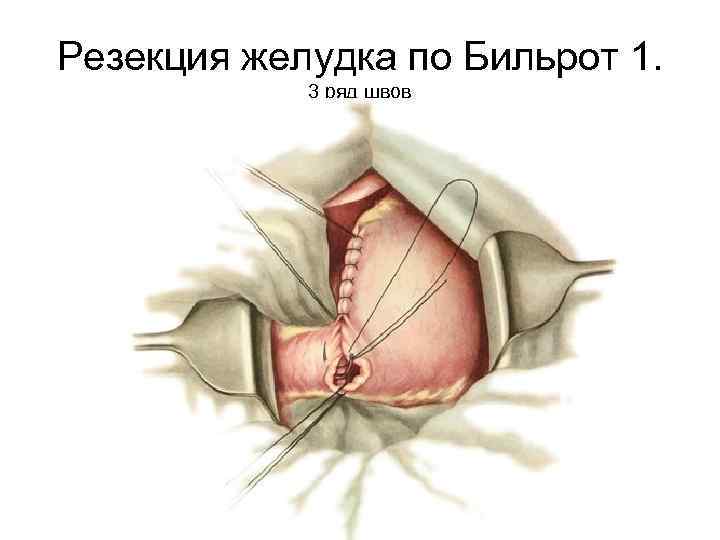 Резекция желудка по Бильрот 1. 3 ряд швов 