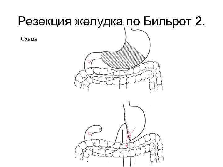 Резекция желудка по Бильрот 2. Схема 