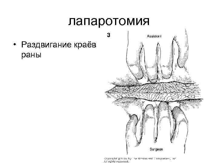 лапаротомия • Раздвигание краёв раны 