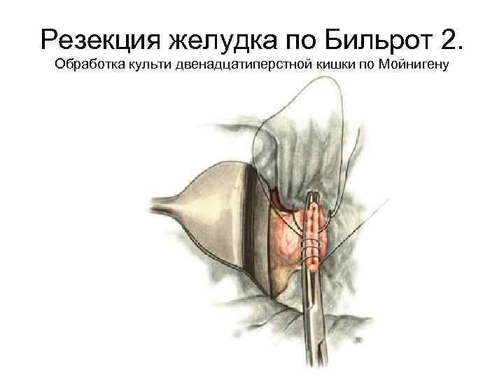 Резекция желудка по Бильрот 2. Обработка культи двенадцатиперстной кишки по Мойнигену 