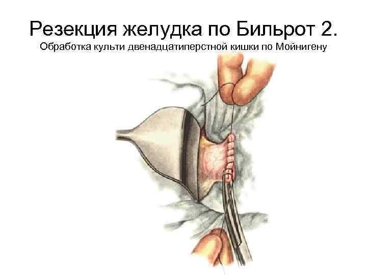 Резекция желудка по Бильрот 2. Обработка культи двенадцатиперстной кишки по Мойнигену 