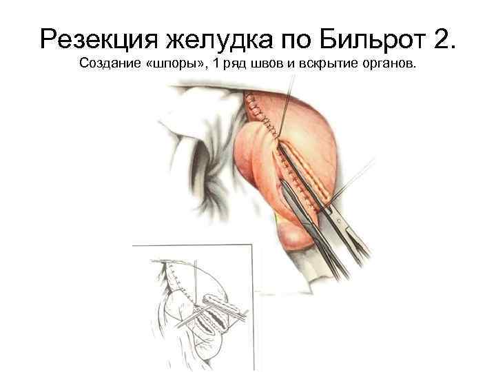 Резекция желудка по Бильрот 2. Создание «шпоры» , 1 ряд швов и вскрытие органов.
