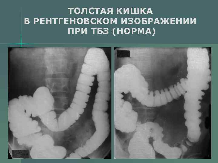 ТОЛСТАЯ КИШКА В РЕНТГЕНОВСКОМ ИЗОБРАЖЕНИИ ПРИ ТБЗ (НОРМА) 