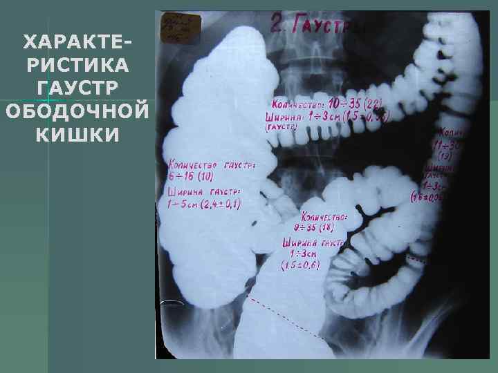 ХАРАКТЕРИСТИКА ГАУСТР ОБОДОЧНОЙ КИШКИ 