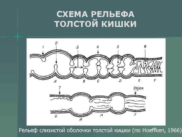 Толстая оболочка. Рельеф слизистой Толстого кишечника. Рельеф слизистой оболочки толстой кишки. Рельеф слизистой оболочки толстый кишки. Структуры рельефа слизистой толстой кишки.