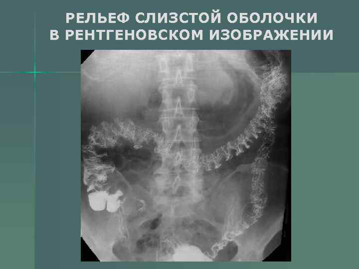 РЕЛЬЕФ СЛИЗСТОЙ ОБОЛОЧКИ В РЕНТГЕНОВСКОМ ИЗОБРАЖЕНИИ 