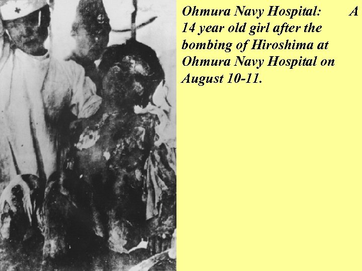 Ohmura Navy Hospital: 14 year old girl after the bombing of Hiroshima at Ohmura