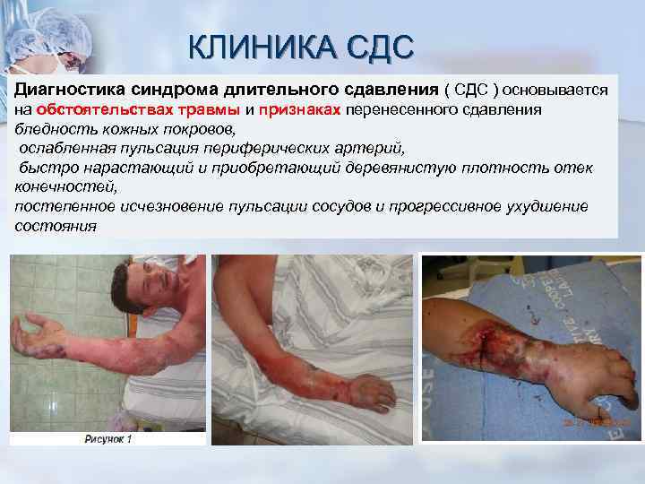 КЛИНИКА СДС Диагностика синдрома длительного сдавления ( СДС ) основывается на обстоятельствах травмы и