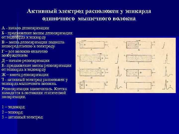 Активный электрод расположен у эпикарда одиночного мышечного волокна А - начало деполяризации Б -