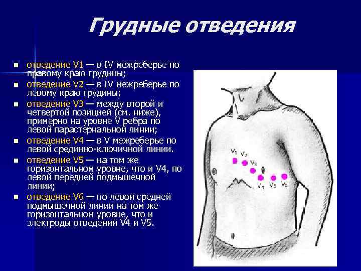 Грудные отведения n n n отведение V 1 — в IV межреберье по правому