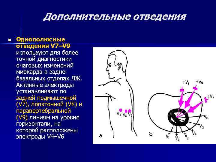 Дополнительные отведения n Однополюсные отведения V 7–V 9 используют для более точной диагностики очаговых