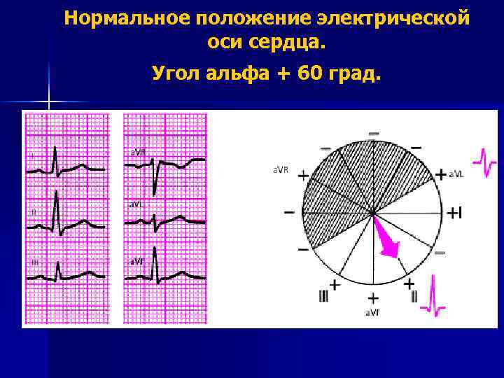 Нормальное положение электрической оси сердца. Угол альфа + 60 град. 