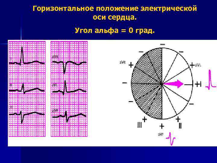 Горизонтальное положение электрической оси сердца. Угол альфа = 0 град. 