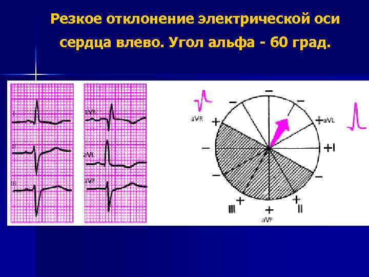 Резкое отклонение электрической оси сердца влево. Угол альфа - 60 град. 