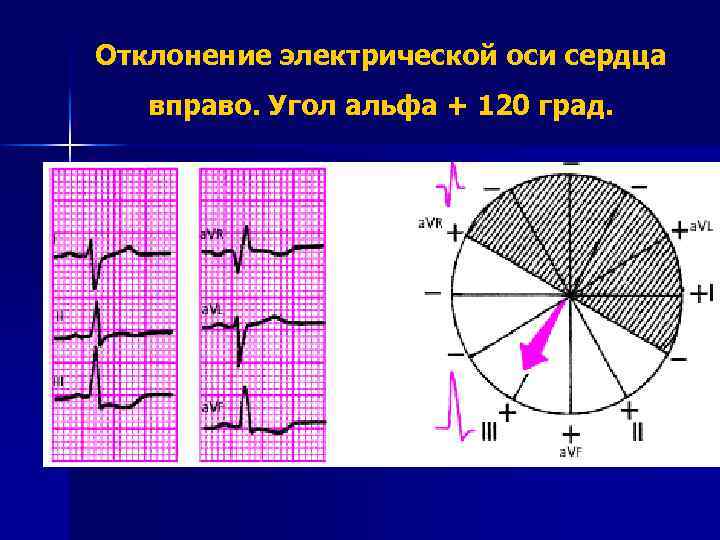 Отклонение электрической оси сердца вправо. Угол альфа + 120 град. 