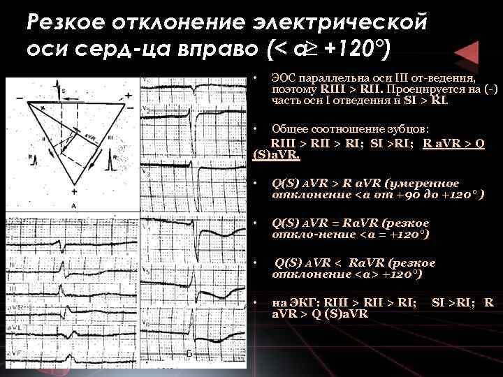 Резкое отклонение электрической оси серд ца вправо (< а≥ +120°) • ЭОС параллельна оси