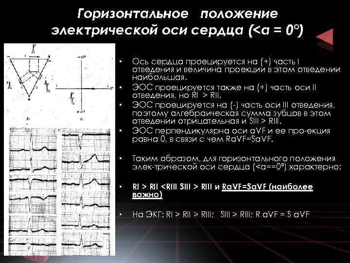 Горизонтальное положение электрической оси сердца (<а = 0°) • • Ось сердца проецируется на