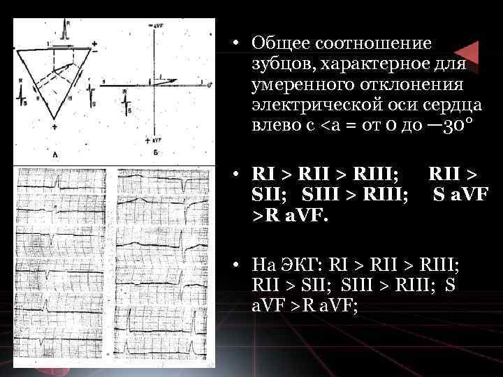  • Общее соотношение зубцов, характерное для умеренного отклонения электрической оси сердца влево с