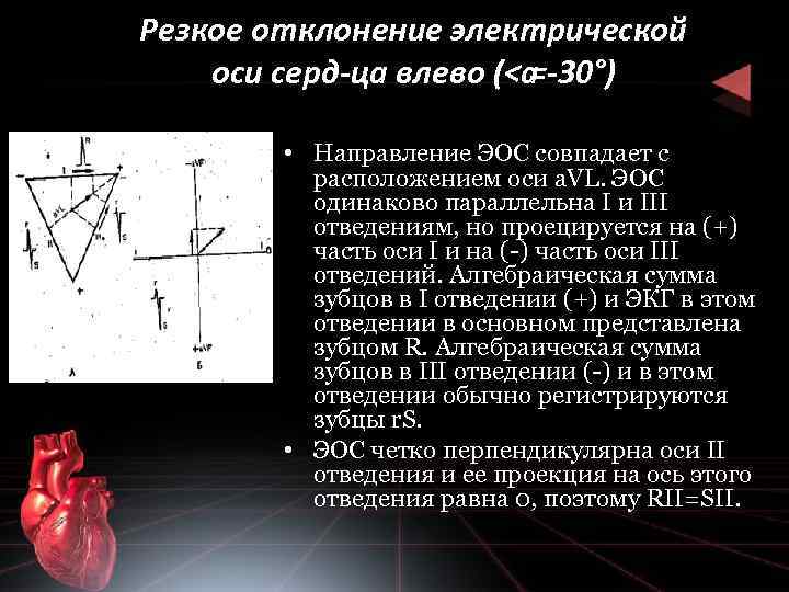 Резкое отклонение электрической оси серд ца влево (<а = 30°) • Направление ЭОС совпадает