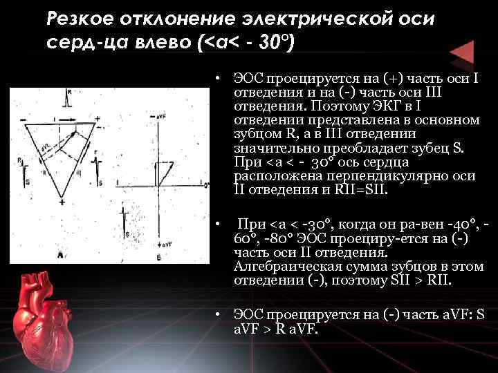 Резкое отклонение электрической оси серд ца влево (<а< 30°) • ЭОС проецируется на (+)