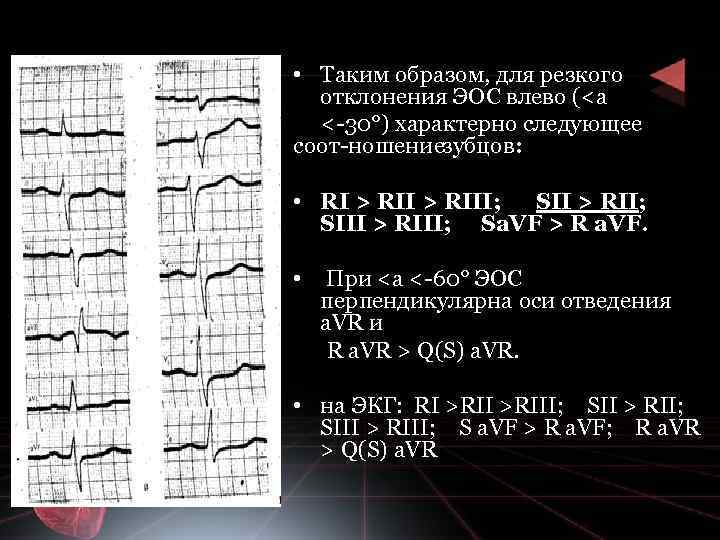  • Таким образом, для резкого отклонения ЭОС влево (<а < 30°) характерно следующее