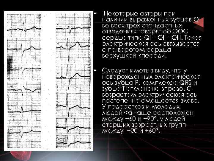  • Некоторые авторы при наличии выраженных зубцов Q во всех трех стандартных отведениях