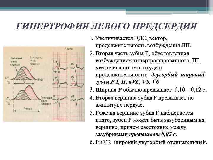 ГИПЕРТРОФИЯ ЛЕВОГО ПРЕДСЕРДИЯ 1. Увеличивается ЭДС, вектор, продолжительность возбуждения ЛП. 2. Вторая часть зубца