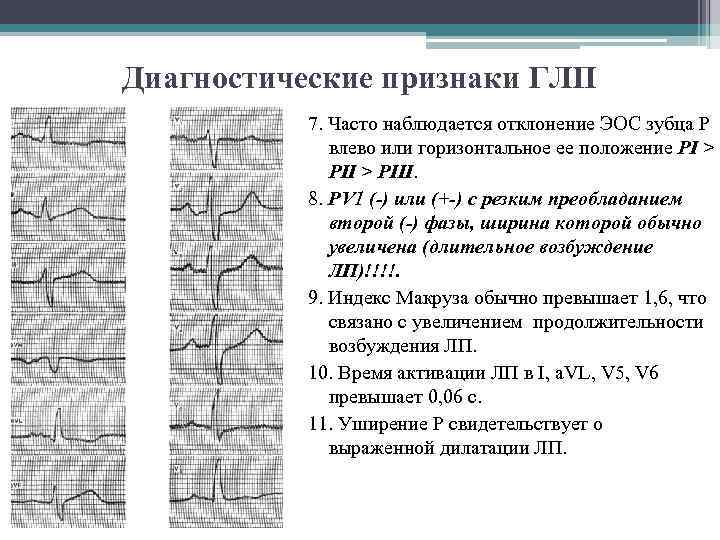 Диагностические признаки ГЛП 7. Часто наблюдается отклонение ЭОС зубца Р влево или горизонтальное ее