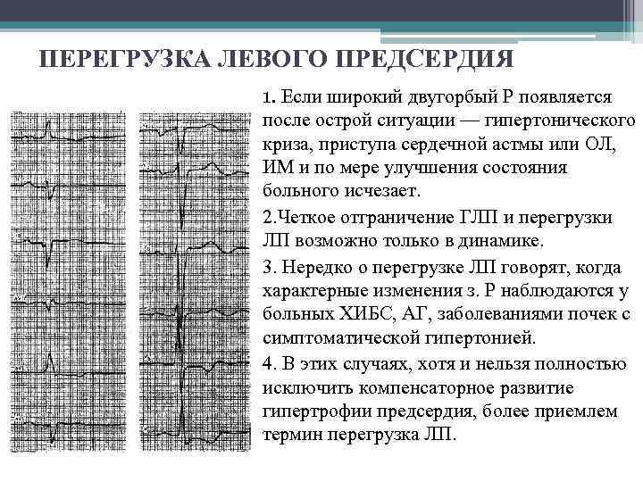 ПЕРЕГРУЗКА ЛЕВОГО ПРЕДСЕРДИЯ 1. Если широкий двугорбый Р появляется после острой ситуации — гипертонического
