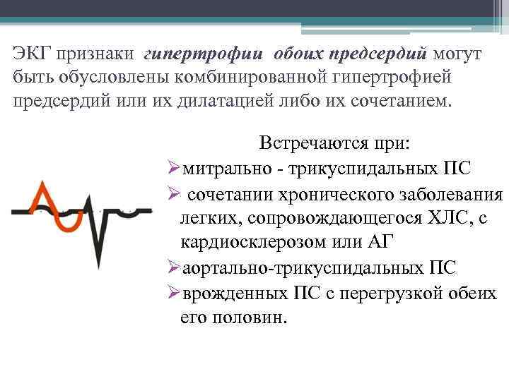 ЭКГ признаки гипертрофии обоих предсердий могут быть обусловлены комбинированной гипертрофией предсердий или их дилатацией