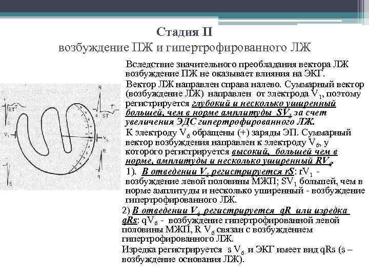 Стадия II возбуждение ПЖ и гипертрофированного ЛЖ Вследствие значительного преобладания вектора ЛЖ возбуждение ПЖ