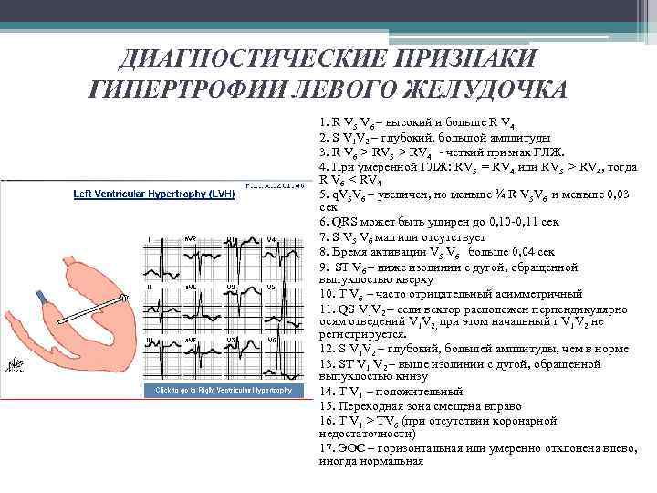 ДИАГНОСТИЧЕСКИЕ ПРИЗНАКИ ГИПЕРТРОФИИ ЛЕВОГО ЖЕЛУДОЧКА 1. R V 5 V 6 – высокий и