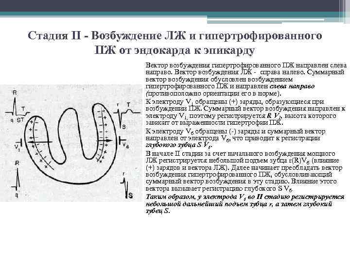 Стадия II - Возбуждение ЛЖ и гипертрофированного ПЖ от эндокарда к эпикарду Вектор возбуждения