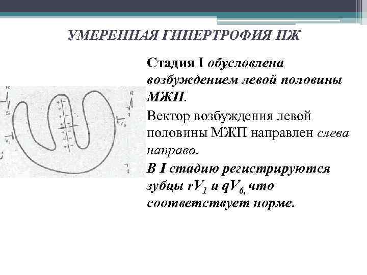 УМЕРЕННАЯ ГИПЕРТРОФИЯ ПЖ Стадия I обусловлена возбуждением левой половины МЖП. Вектор возбуждения левой половины
