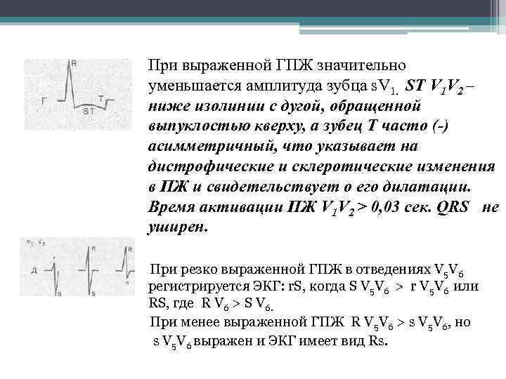 При выраженной ГПЖ значительно уменьшается амплитуда зубца s. V 1. ST V 1 V