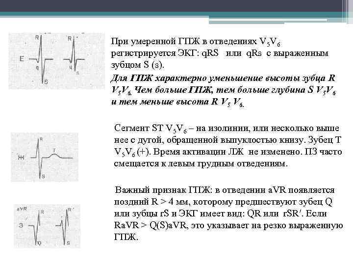 При умеренной ГПЖ в отведениях V 5 V 6 регистрируется ЭКГ: q. RS или
