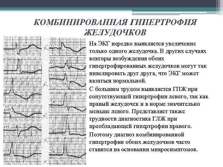 КОМБИНИРОВАННАЯ ГИПЕРТРОФИЯ ЖЕЛУДОЧКОВ На ЭКГ нередко выявляется увеличение только одного желудочка. В других случаях