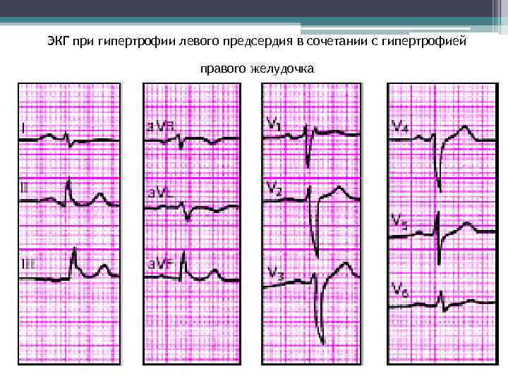 ЭКГ при гипертрофии левого предсердия в сочетании с гипертрофией правого желудочка 