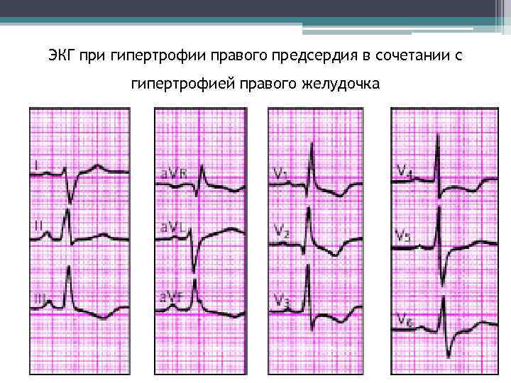 ЭКГ при гипертрофии правого предсердия в сочетании с гипертрофией правого желудочка 