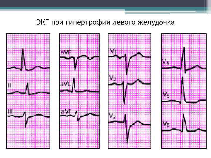 ЭКГ при гипертрофии левого желудочка 