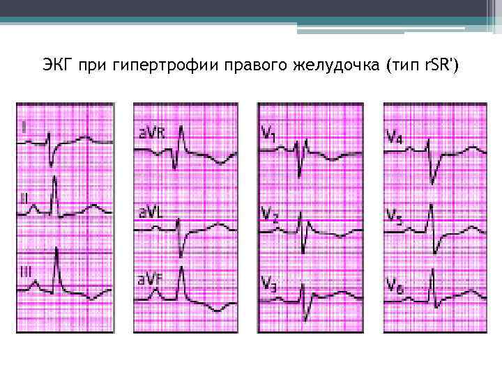 ЭКГ при гипертрофии правого желудочка (тип r. SR') 