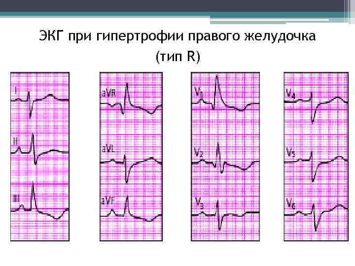 ЭКГ при гипертрофии правого желудочка (тип R) 