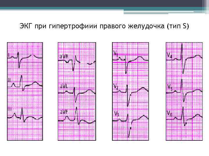 ЭКГ при гипертрофиии правого желудочка (тип S) 